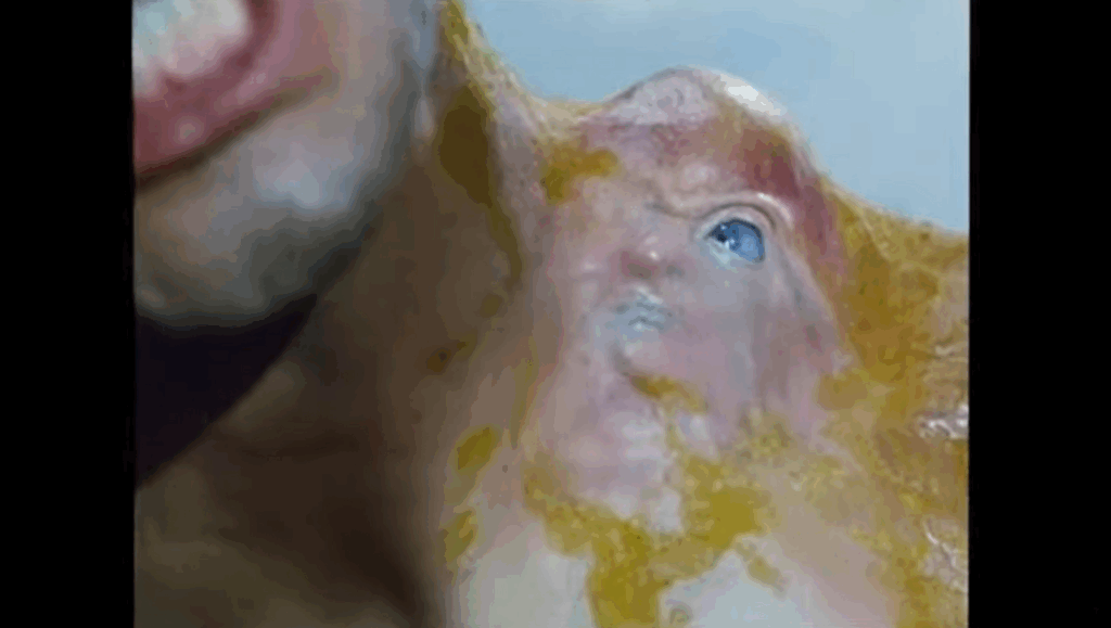 Closeup of the growing boil with a rudimentary face including a single blue eye.